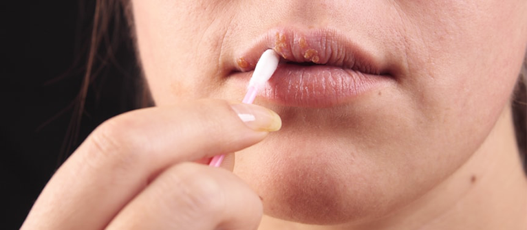 Herpes simples na perna sintomas